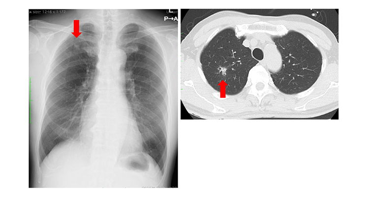 原発性肺癌（右上葉肺癌）の胸部レントゲン写真と胸部CT。矢印は原発性肺癌を示しています。