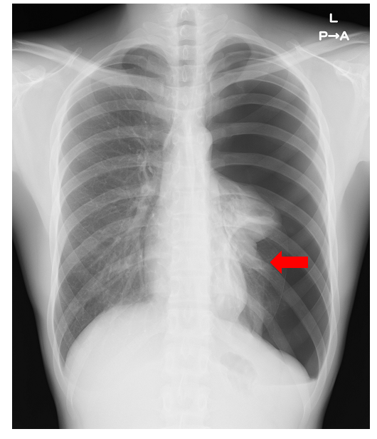 左気胸の胸部レントゲン写真。矢印は気胸により虚脱した肺を示しています。