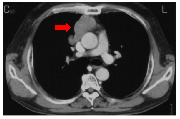 胸腺腫の胸部CT。矢印が胸腺腫の腫瘍を示しています。