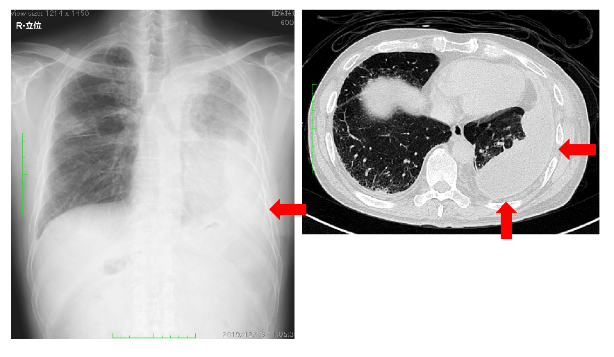 左膿胸の胸部レントゲン 写真と胸部CT。矢印は膿胸部分を示しています。