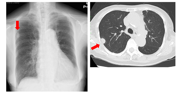 転移性肺腫瘍の胸部レントゲン写真と胸部CT。矢印は転移性肺腫瘍の結節を示しています。