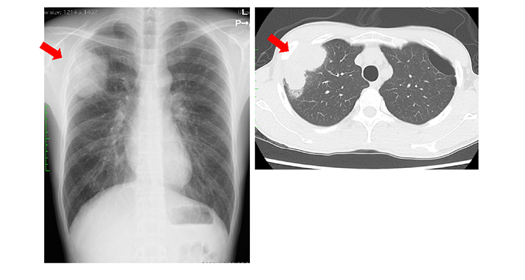 胸壁へ浸潤した原発性肺癌の胸部レントゲン写真と胸部CT。矢印は原発性肺癌が胸壁へ浸潤しているところを示しています。