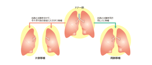 肺移植のためのガイドブックより